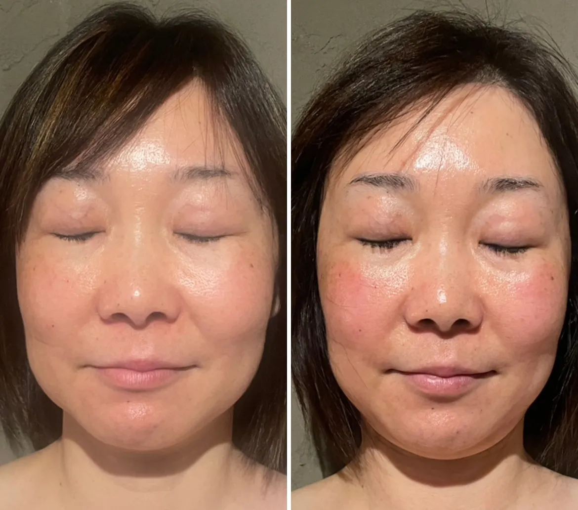 インディバXREVIハーブピーリング　