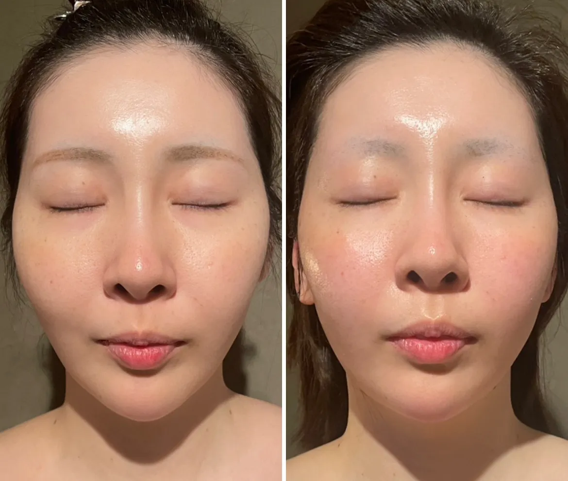 インディバXREVIハーブピーリング