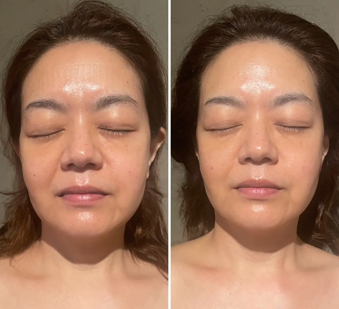 インディバXREVIハーブピーリング