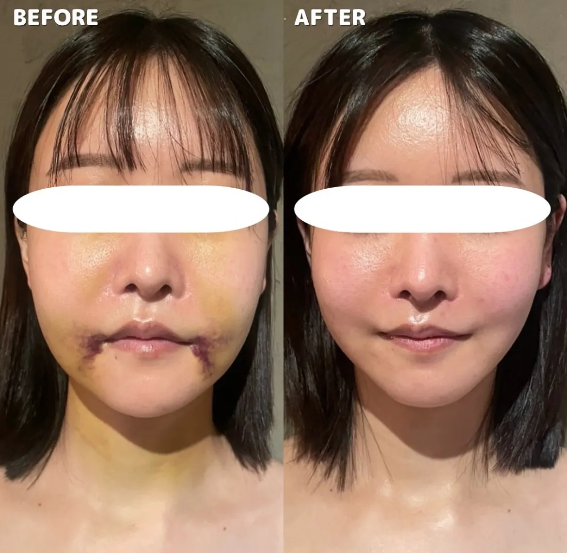 顎下脂肪吸引　術後1ヶ月