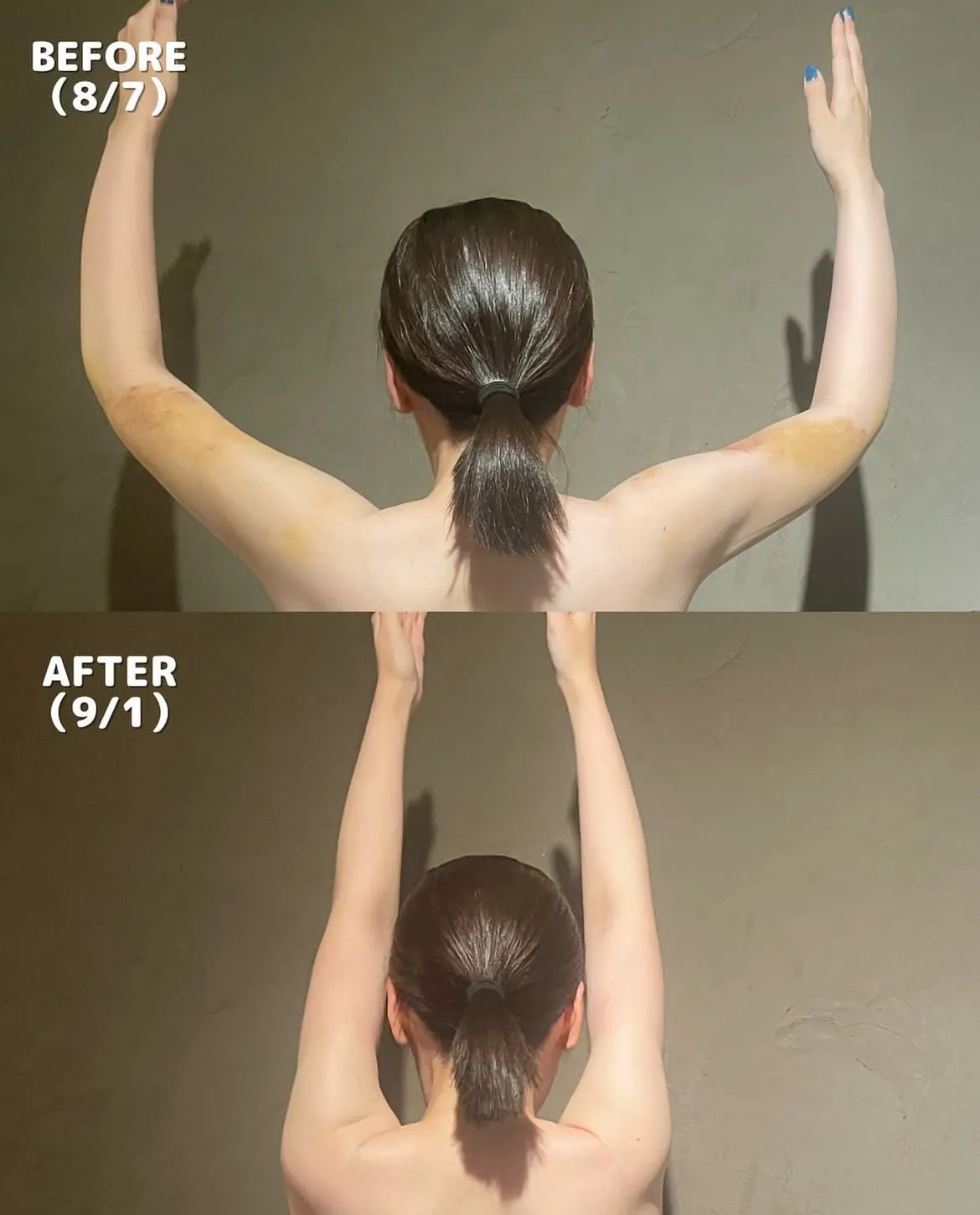 二の腕脂肪吸引　術後約１ヶ月