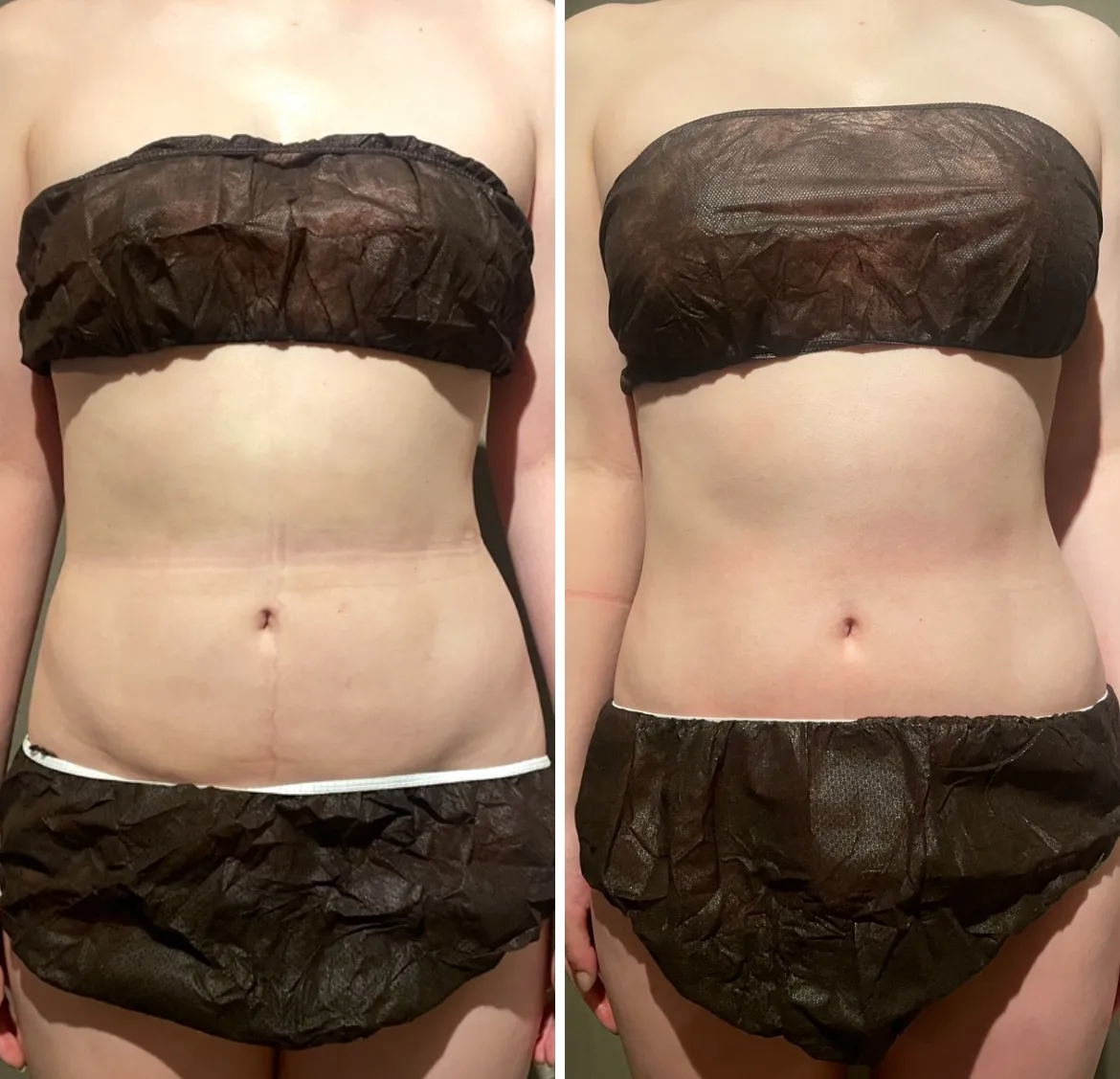 お腹脂肪吸引　術後１ヶ月