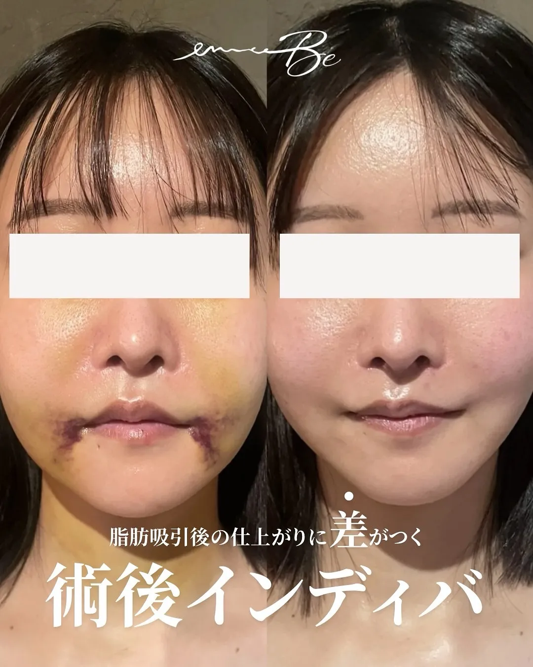 【術後インディバでの劇的変化】
