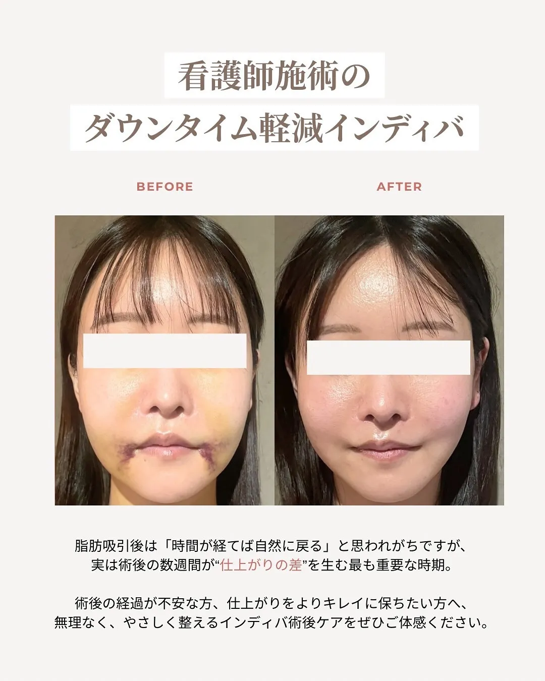 【術後インディバでの劇的変化】